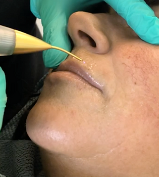 Opleiding Xtreme Plasma Lift - Ecuri Academy